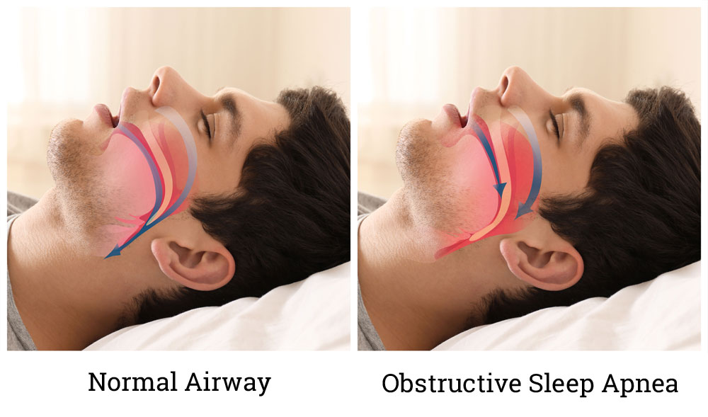 obstructive sleep apnea Mansfield TX